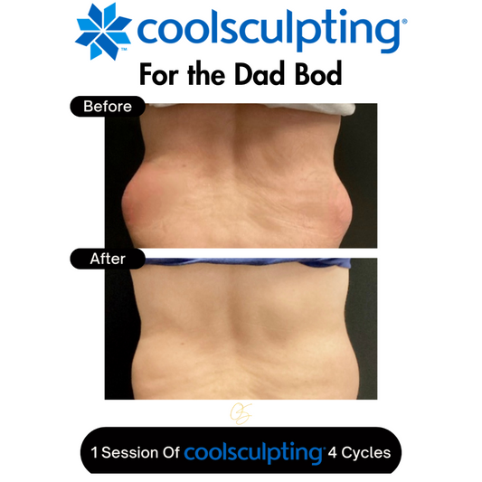 CoolSculpting Dad Bod Save $200!